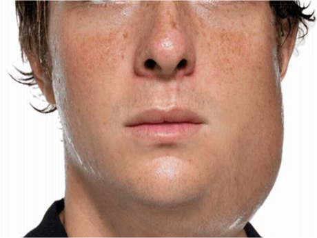 male afflicted with mumps
