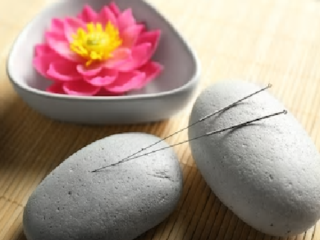 acupuncture needles on stones